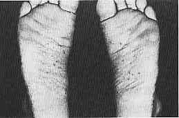 掌蹠膿疱症蹠部(足底)の膿疱