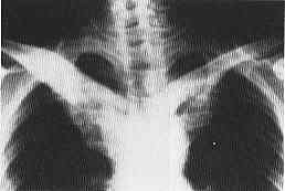 掌蹠膿疱症の胸部レントゲン