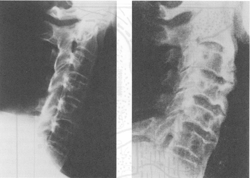 ＡＳとＡＳＨの頸椎レントゲン写真の比較