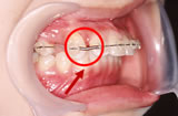 前から４番目の歯を抜いて、そのスペースに、前から３番目の歯を動かしています。