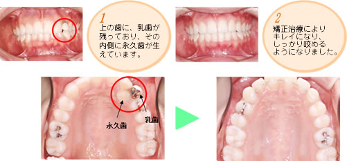 上の歯に、乳歯が残っており、その内側に永久歯が生えています。　矯正治療によりキレイになり、しっかり咬めるようになりました。　
