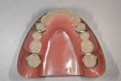 メタルクラスプ義歯