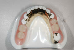 ノンメタルクラスプ義歯