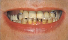 マグネット式義歯　治療前