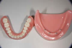 メタルクラスプ義歯